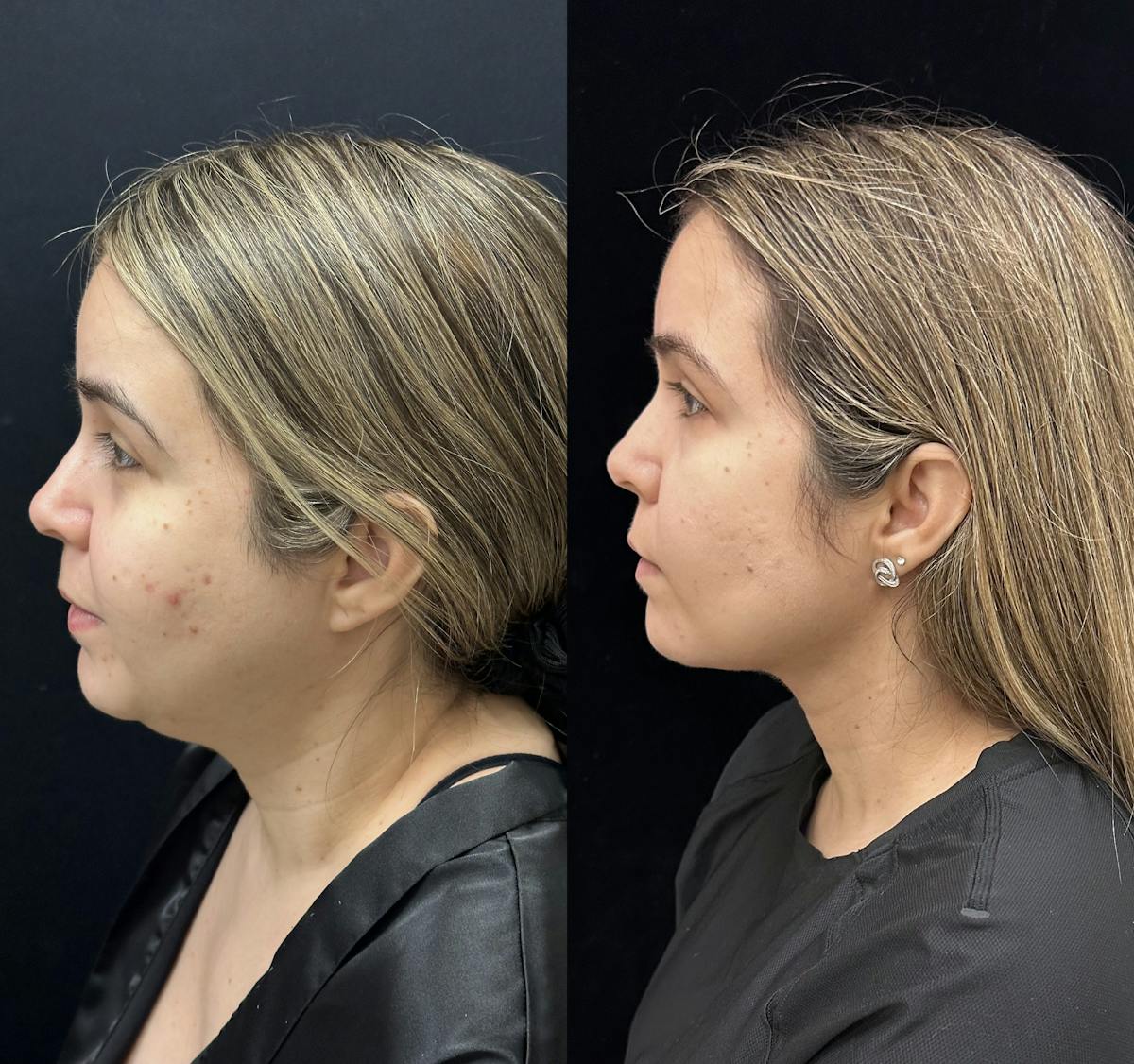 Buccal Fat Reduction Before & After Gallery - Patient 264180 - Image 4