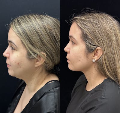 Buccal Fat Reduction Before & After Gallery - Patient 264180 - Image 4