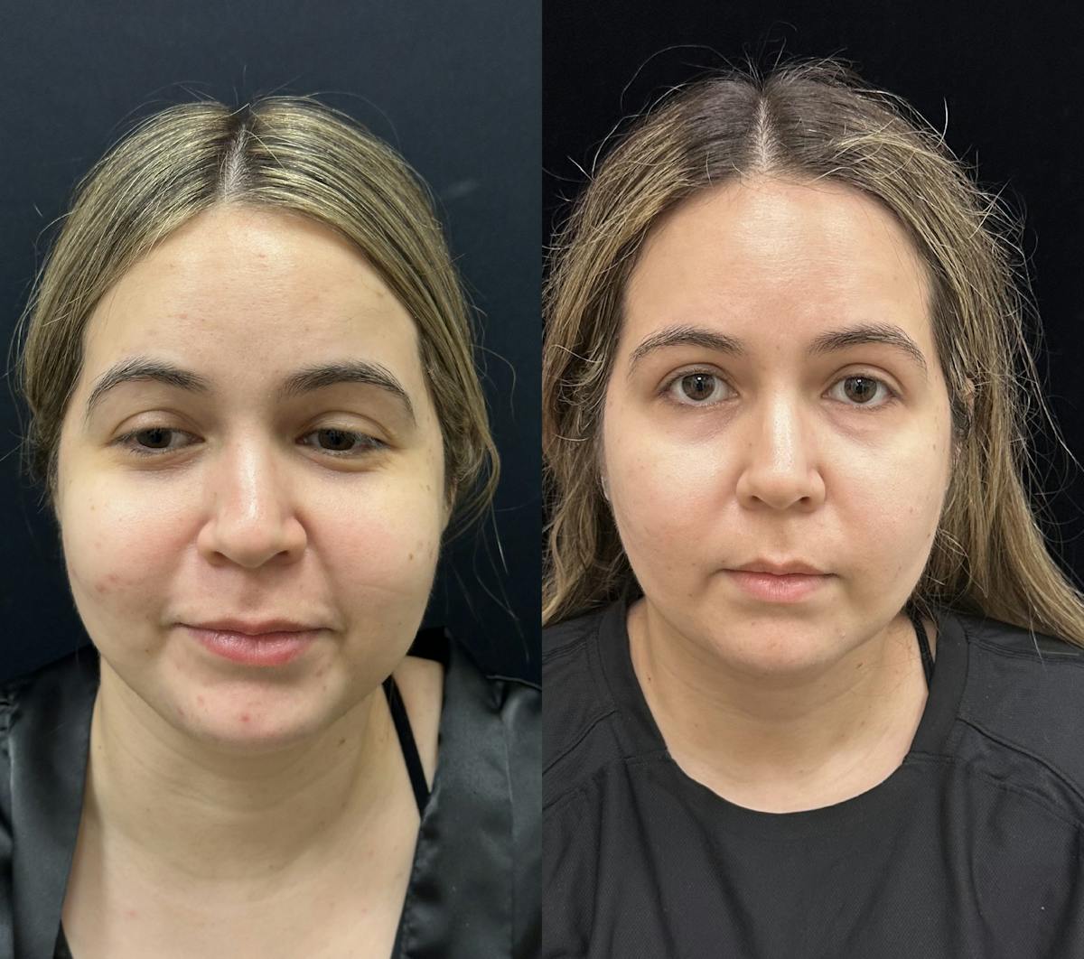 Buccal Fat Reduction Before & After Gallery - Patient 264180 - Image 5
