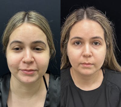 Buccal Fat Reduction Before & After Gallery - Patient 264180 - Image 5