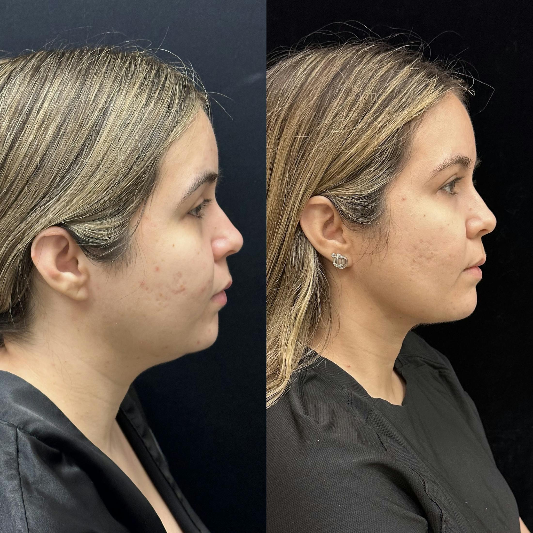 Chin & Neck Lipo Sculpting Before & After Gallery - Patient 309190 - Image 2