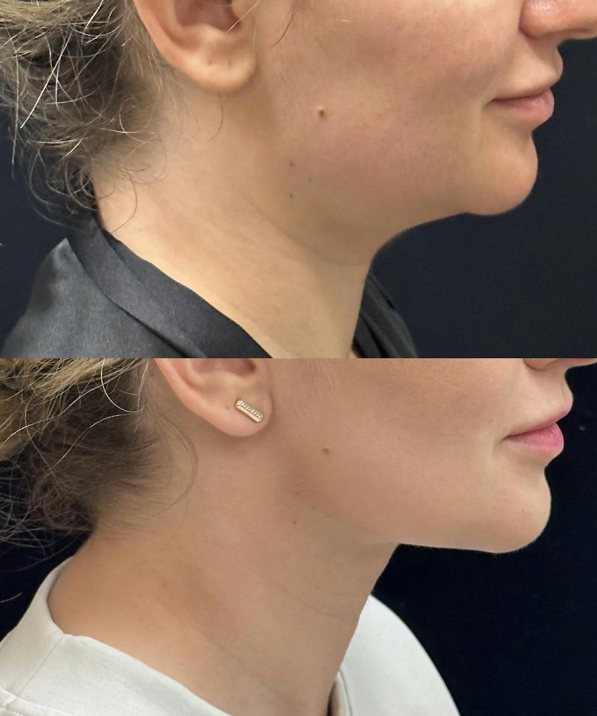 Chin & Neck Lipo Sculpting Before & After Gallery - Patient 190661 - Image 3