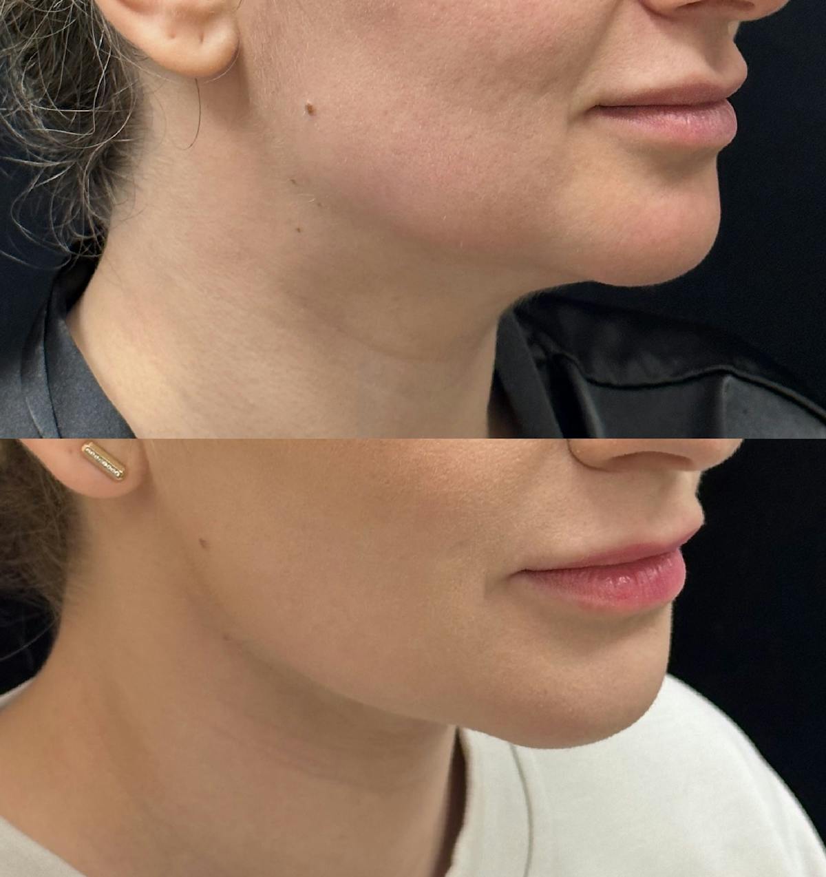 Chin & Neck Lipo Sculpting Before & After Gallery - Patient 190661 - Image 2