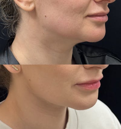 Buccal Fat Reduction Before & After Gallery - Patient 164318 - Image 2