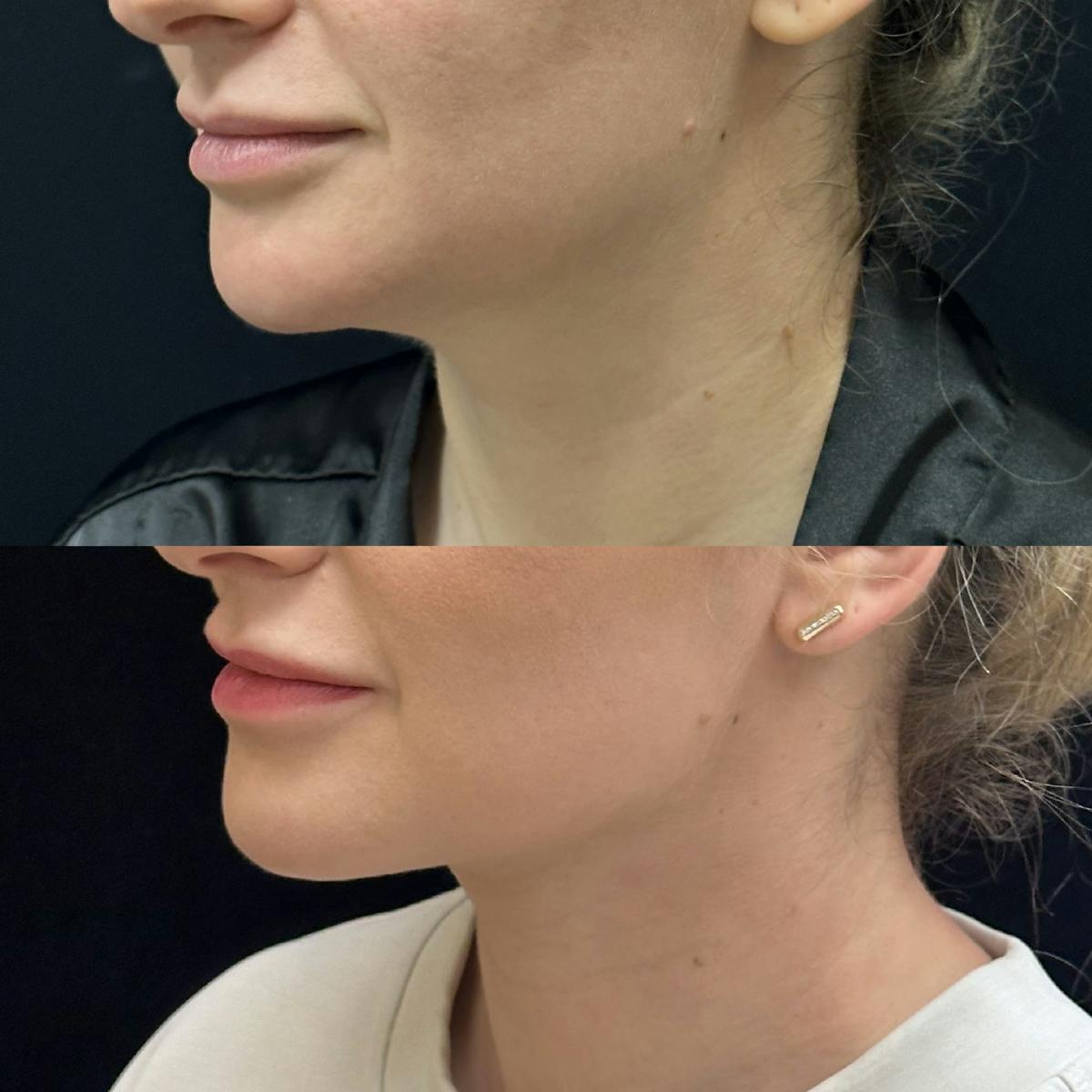 Chin & Neck Lipo Sculpting Before & After Gallery - Patient 190661 - Image 1