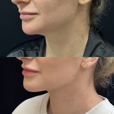 Facial Slimming Surgery Before & After Gallery - Patient 248125 - Image 1