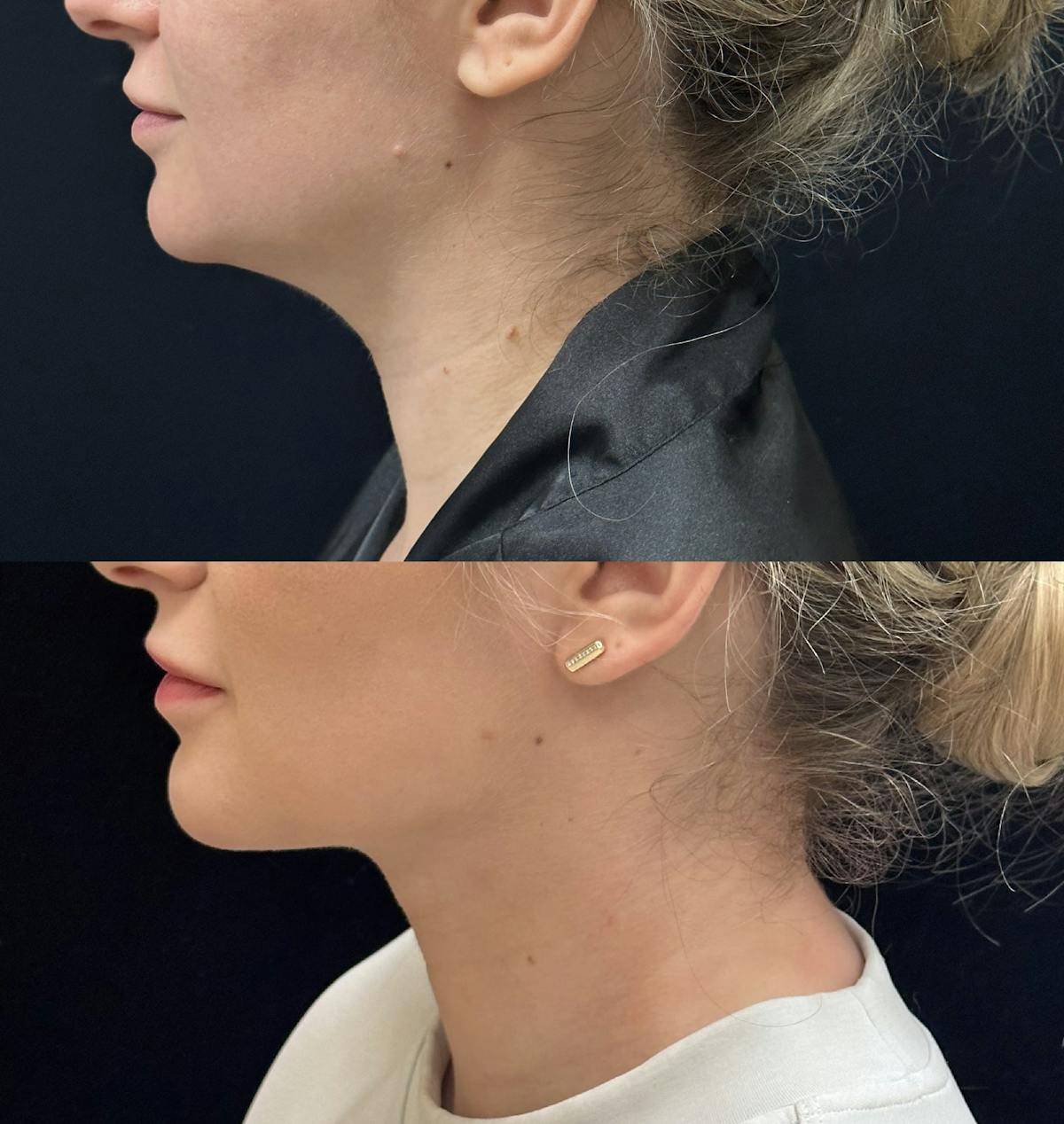 Chin & Neck Lipo Sculpting Before & After Gallery - Patient 190661 - Image 4