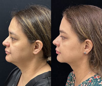 Chin & Neck Lipo Sculpting Before & After Gallery - Patient 411498 - Image 1