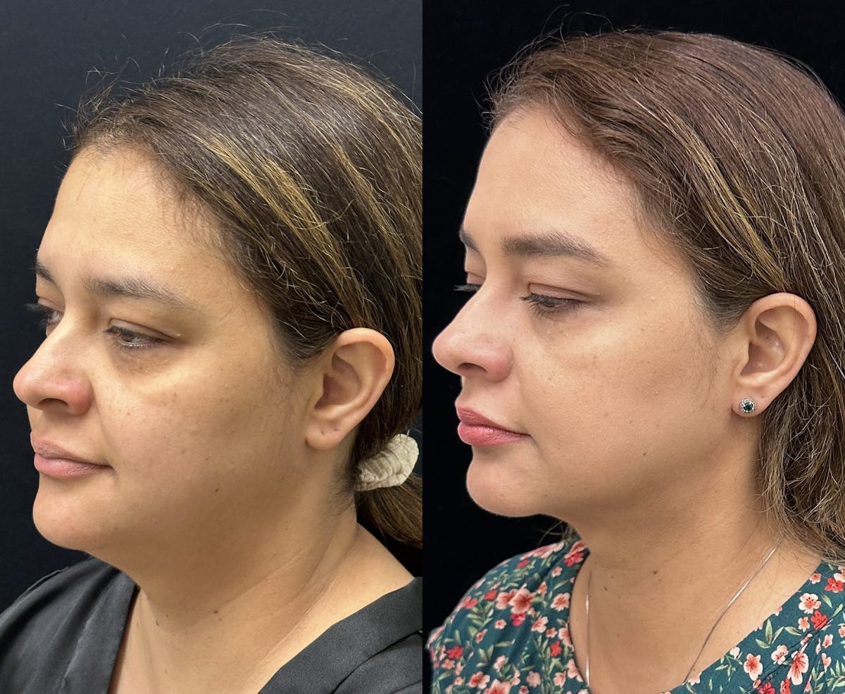 Chin & Neck Lipo Sculpting Before & After Gallery - Patient 411498 - Image 2