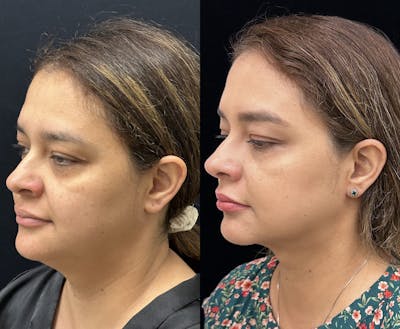 Chin & Neck Lipo Sculpting Before & After Gallery - Patient 411498 - Image 2