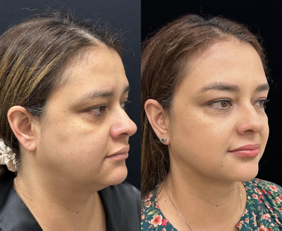 Chin & Neck Lipo Sculpting Before & After Gallery - Patient 411498 - Image 3