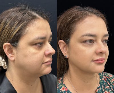 Chin & Neck Lipo Sculpting Before & After Gallery - Patient 411498 - Image 3