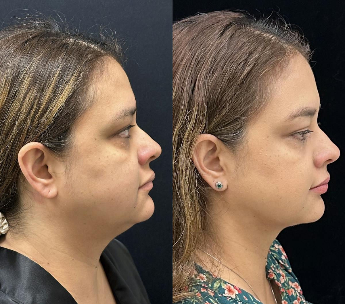 Chin & Neck Lipo Sculpting Before & After Gallery - Patient 411498 - Image 4