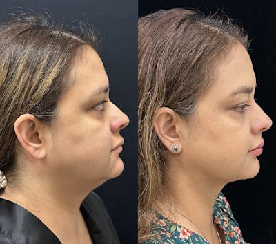 Chin & Neck Lipo Sculpting Before & After Gallery - Patient 411498 - Image 4