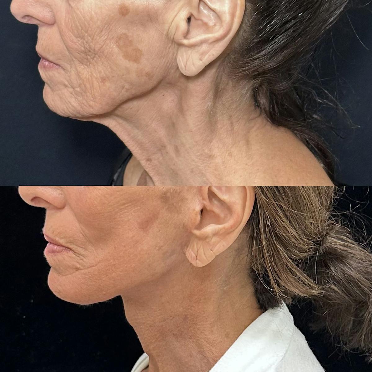 Necklift Before & After Gallery - Patient 426186 - Image 1
