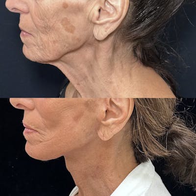 Deep Plane Facelift Before & After Gallery - Patient 383298 - Image 2