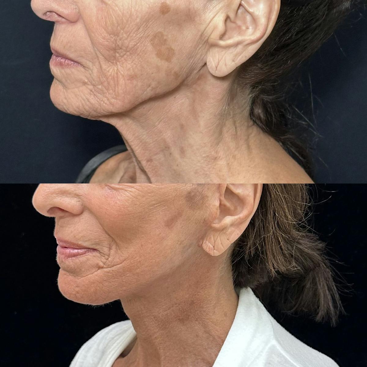 Necklift Before & After Gallery - Patient 426186 - Image 5