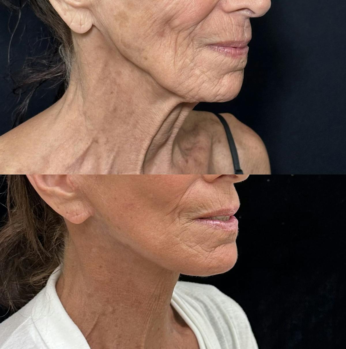 Necklift Before & After Gallery - Patient 426186 - Image 4
