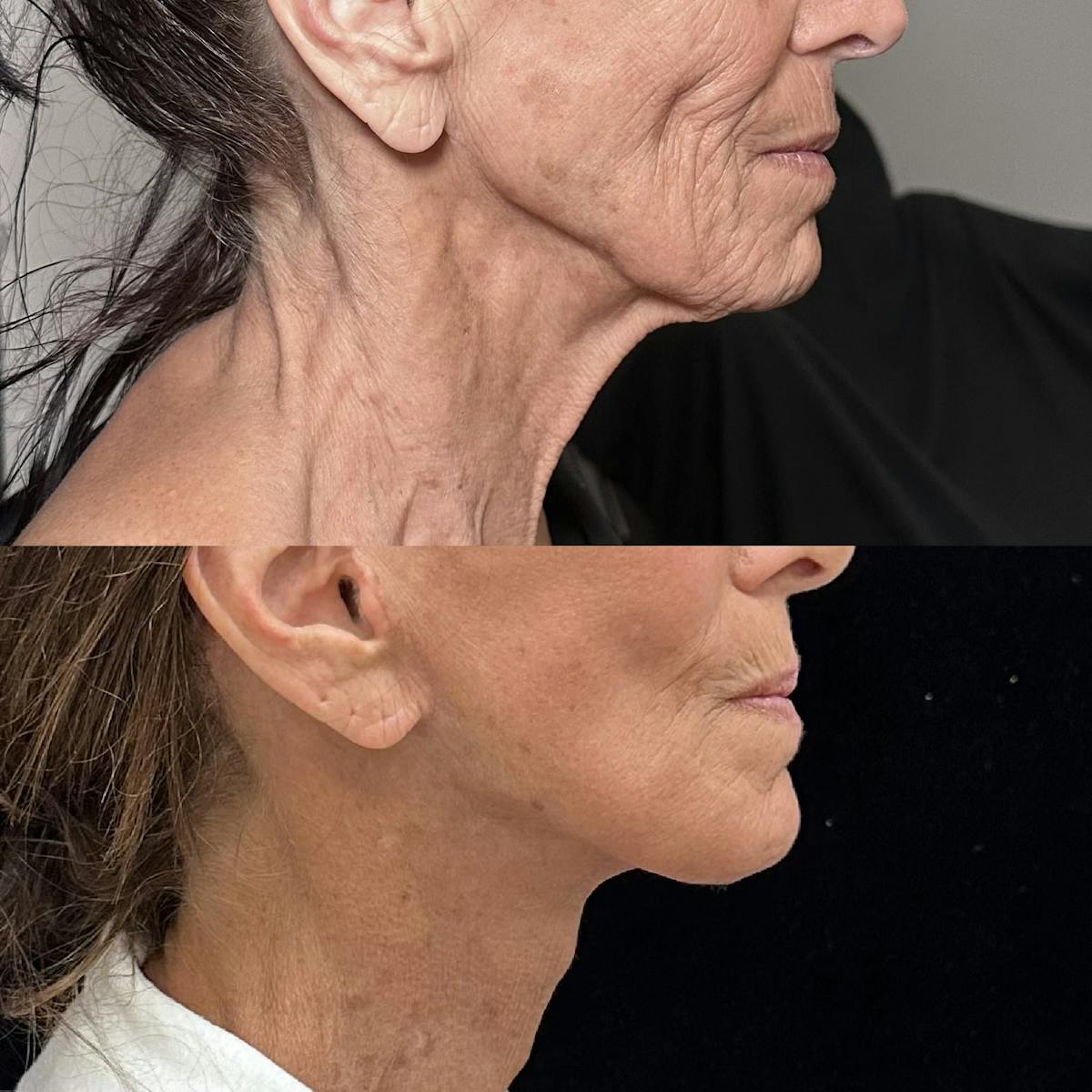 Necklift Before & After Gallery - Patient 426186 - Image 3