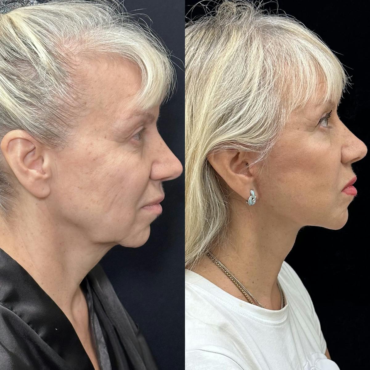 Necklift Before & After Gallery - Patient 329409 - Image 2