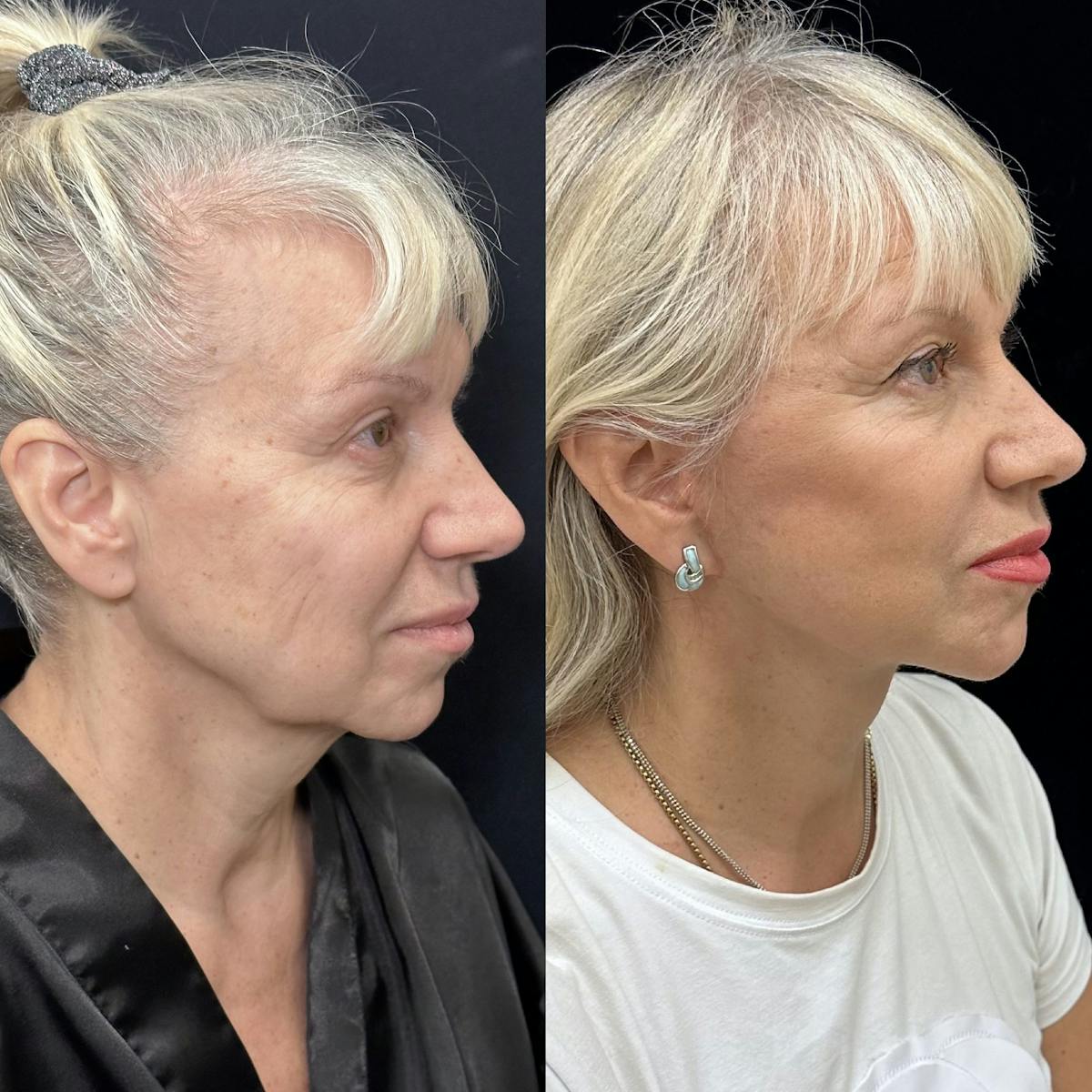 Necklift Before & After Gallery - Patient 329409 - Image 4