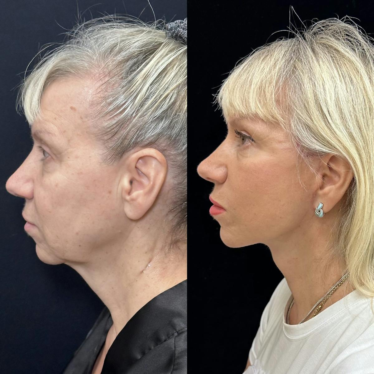 Necklift Before & After Gallery - Patient 329409 - Image 1