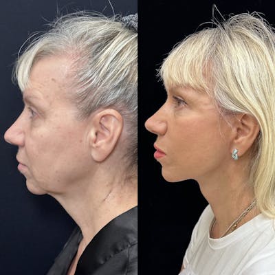 Deep Plane Facelift Before & After Gallery - Patient 614273 - Image 1