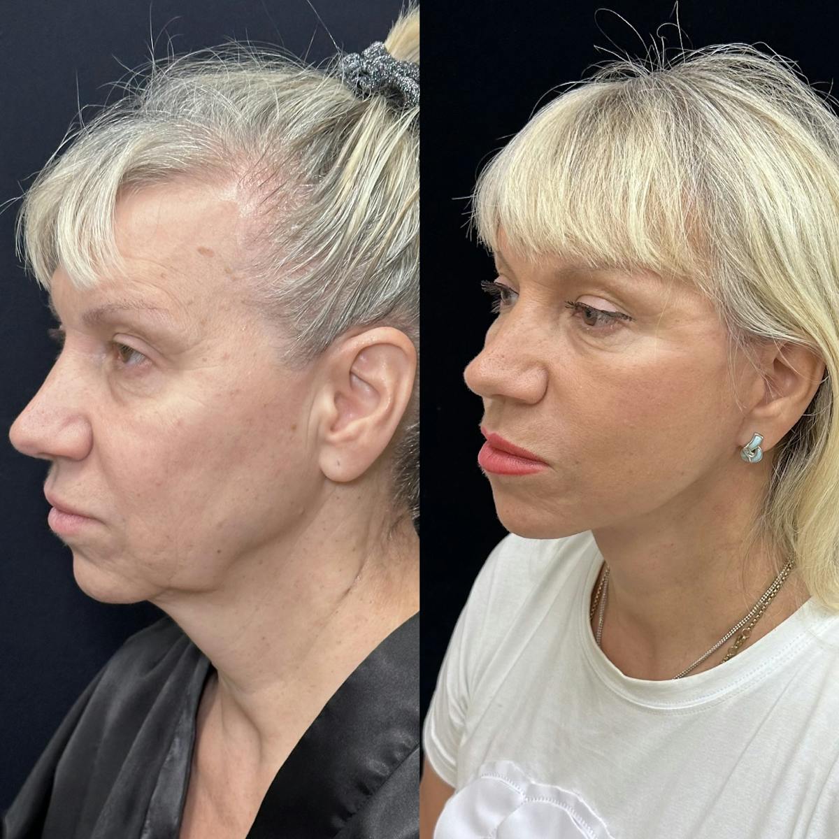 Necklift Before & After Gallery - Patient 329409 - Image 3
