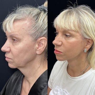 Deep Plane Facelift Before & After Gallery - Patient 614273 - Image 3