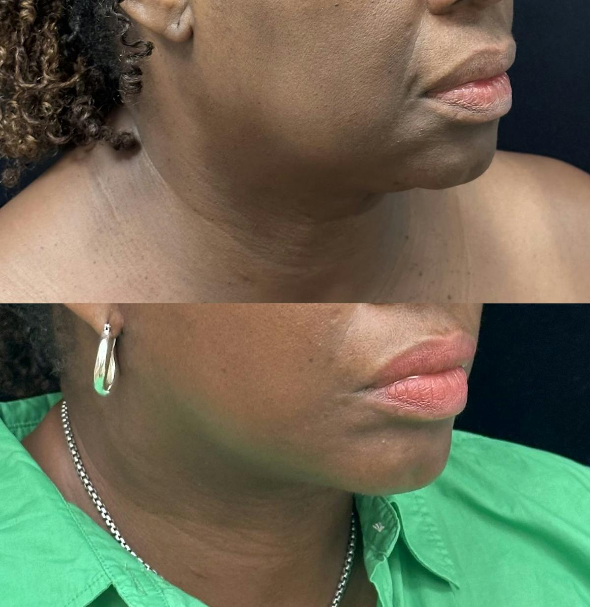 Deep Plane Facelift Before & After Gallery - Patient 402569 - Image 4