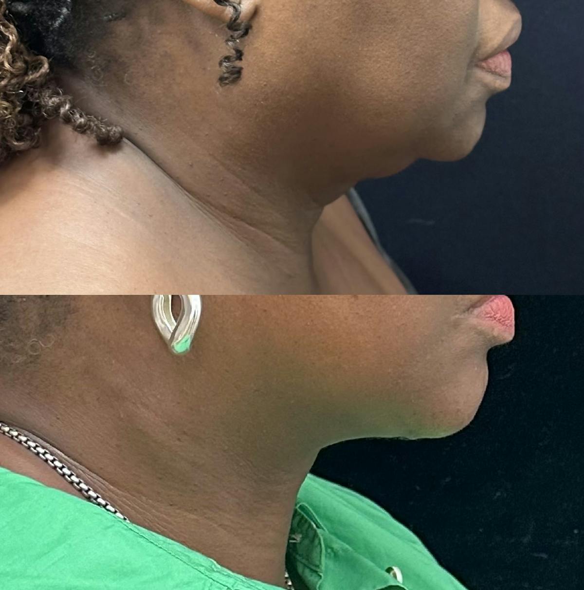 Deep Plane Facelift Before & After Gallery - Patient 402569 - Image 1