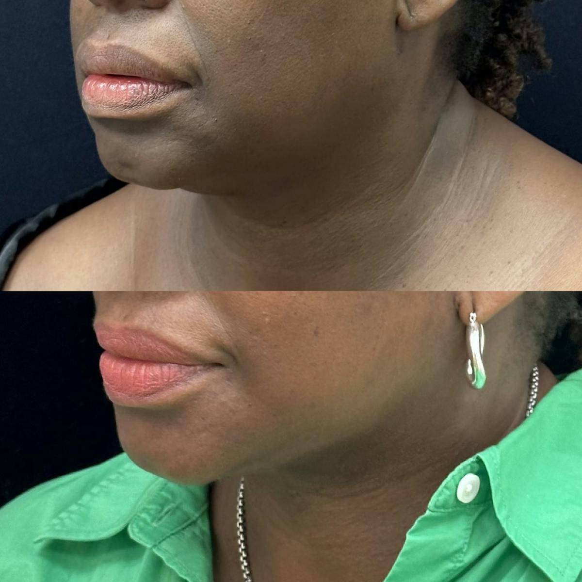 Deep Plane Facelift Before & After Gallery - Patient 402569 - Image 2