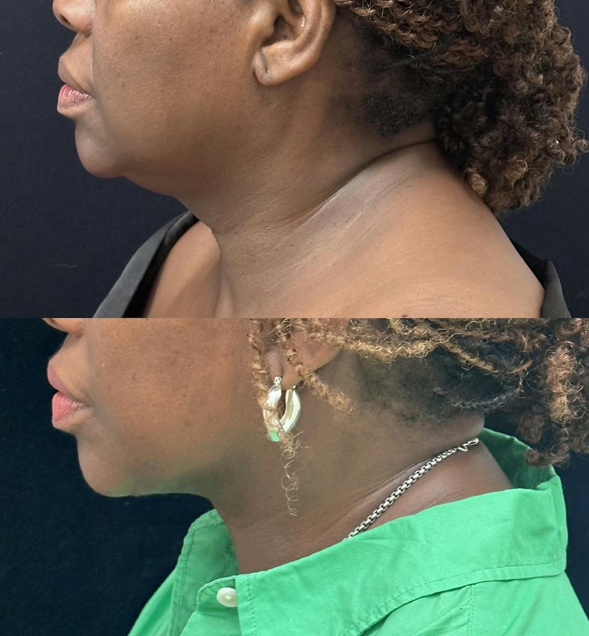 Deep Plane Facelift Before & After Gallery - Patient 402569 - Image 3