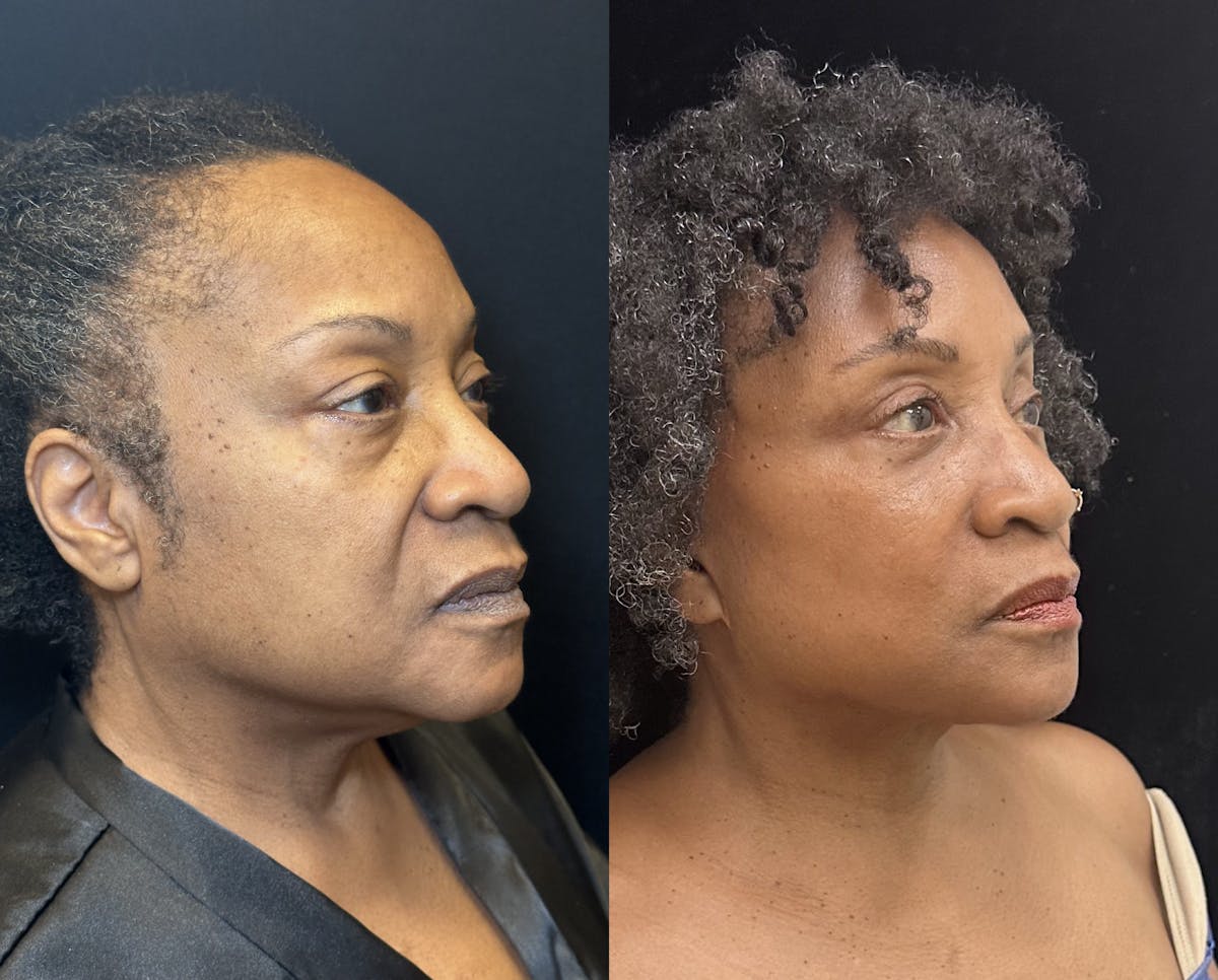 Ethnic Facelift Before & After Gallery - Patient 267257 - Image 4
