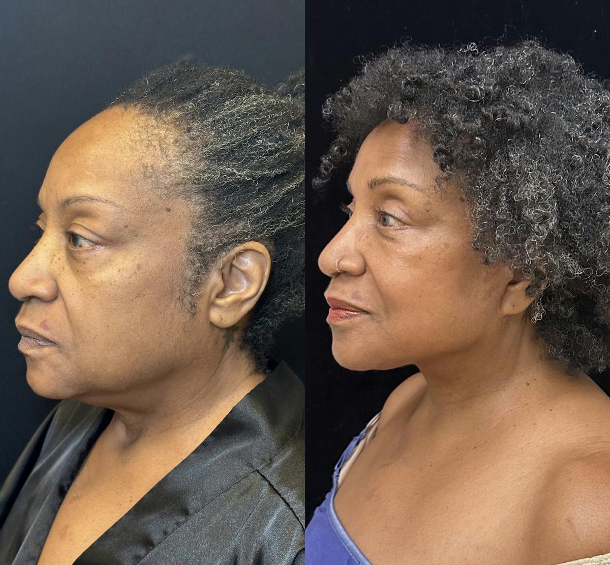 Ethnic Facelift Before & After Gallery - Patient 267257 - Image 2