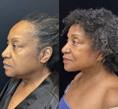 Deep Plane Facelift Before & After Gallery - Patient 243131 - Image 2