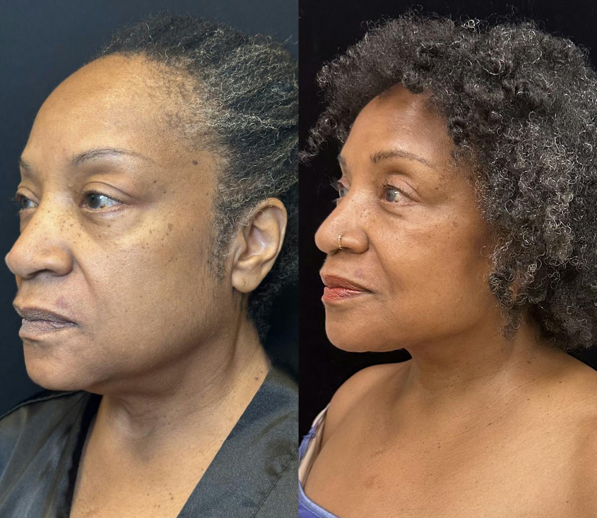 Ethnic Facelift Before & After Gallery - Patient 267257 - Image 5