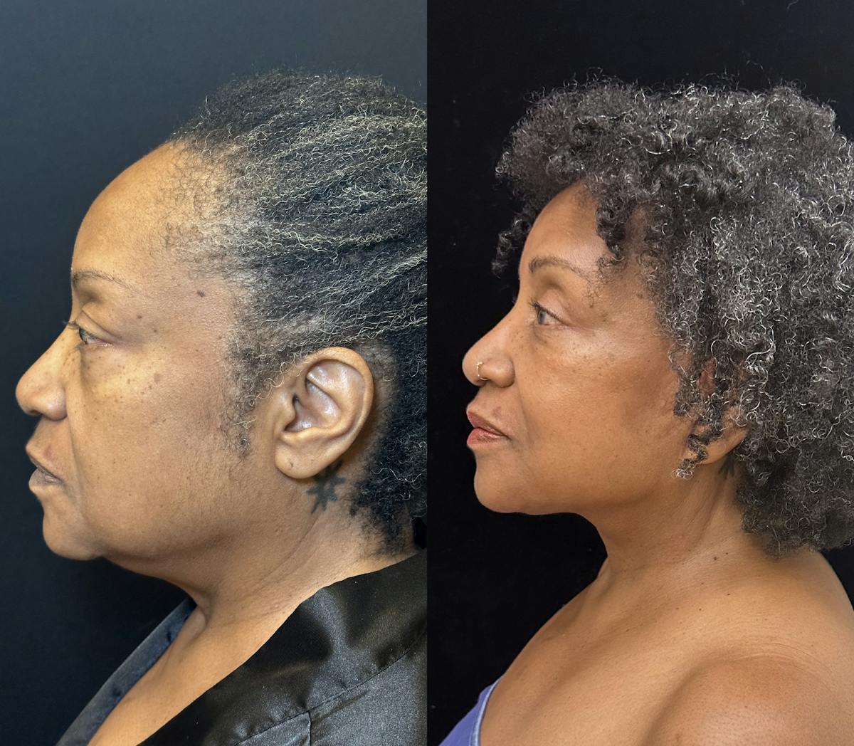 Ethnic Facelift Before & After Gallery - Patient 267257 - Image 1
