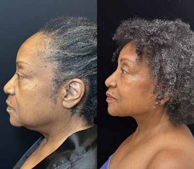 Deep Plane Facelift Before & After Gallery - Patient 243131 - Image 1