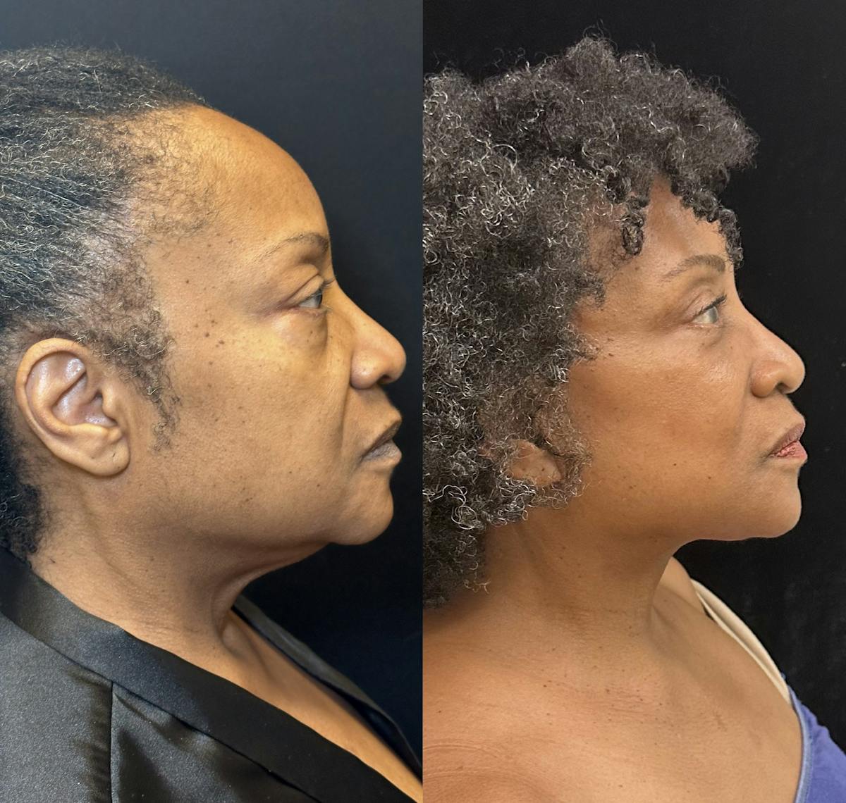 Ethnic Facelift Before & After Gallery - Patient 267257 - Image 3