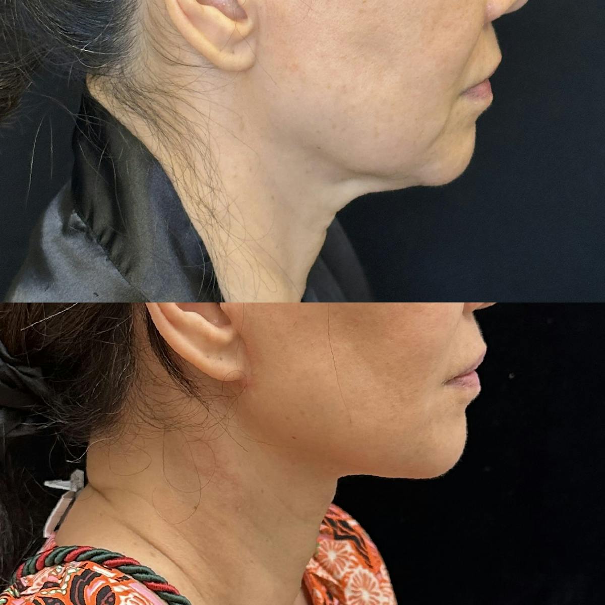Necklift Before & After Gallery - Patient 275659 - Image 2