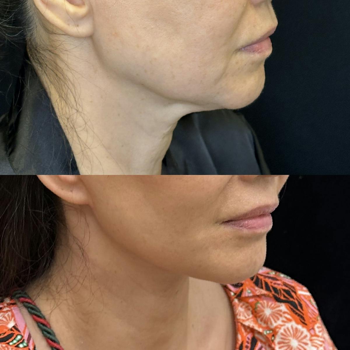Necklift Before & After Gallery - Patient 275659 - Image 1