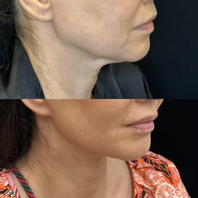 Deep Plane Facelift Before & After Gallery - Patient 379716 - Image 1
