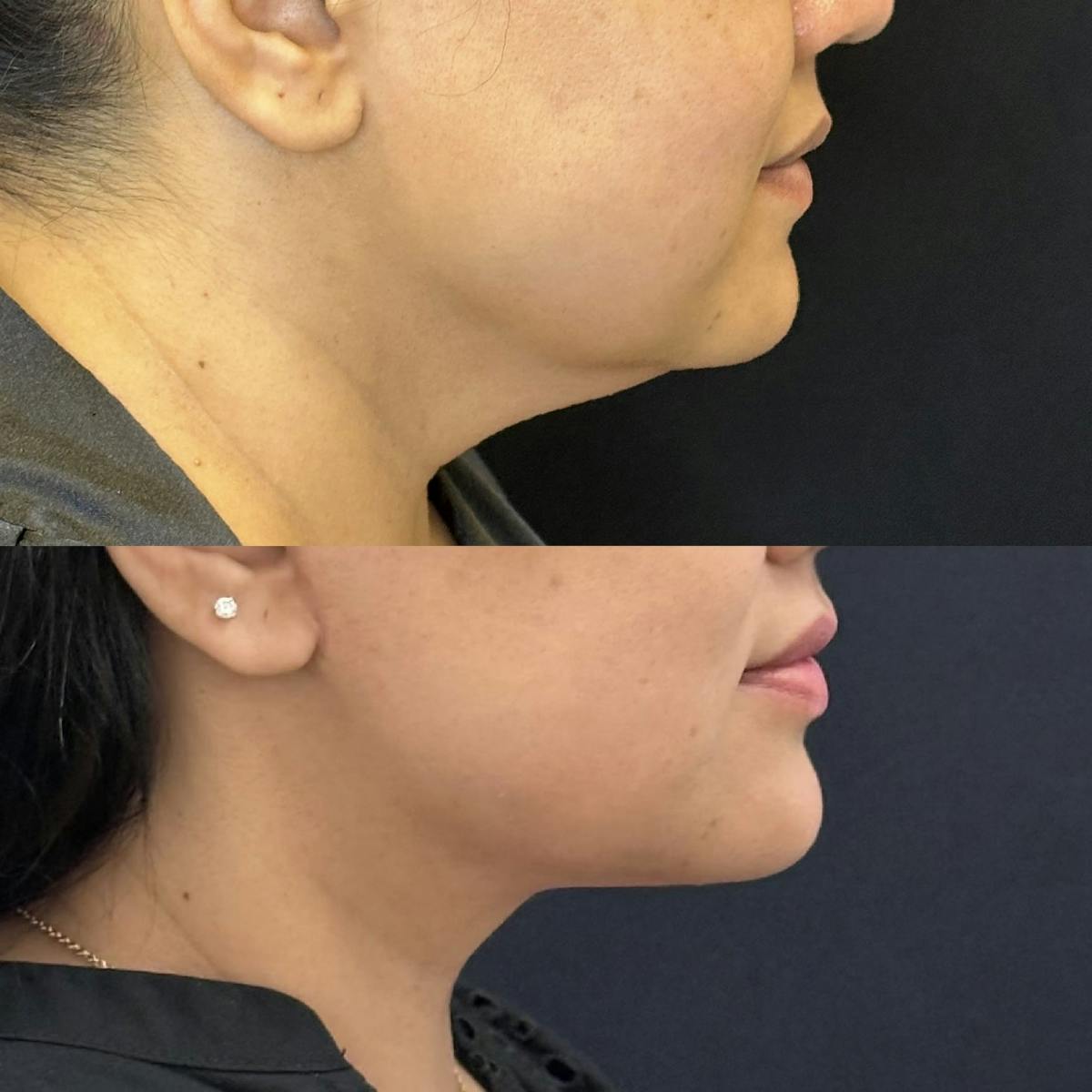 Necklift Before & After Gallery - Patient 310344 - Image 1