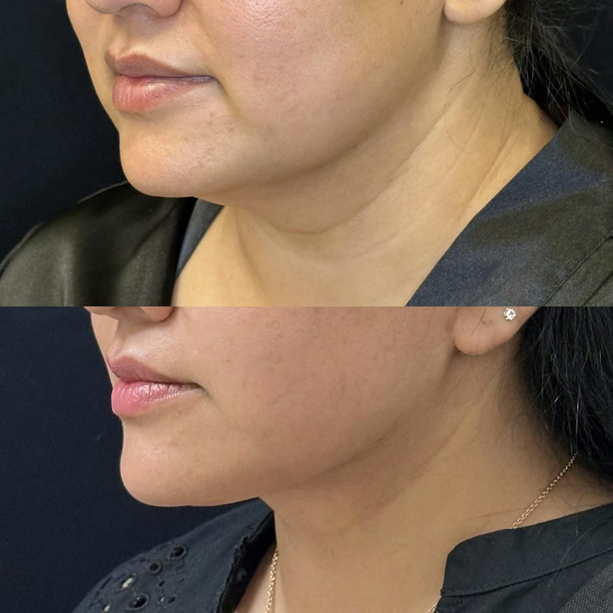 Necklift Before & After Gallery - Patient 310344 - Image 2