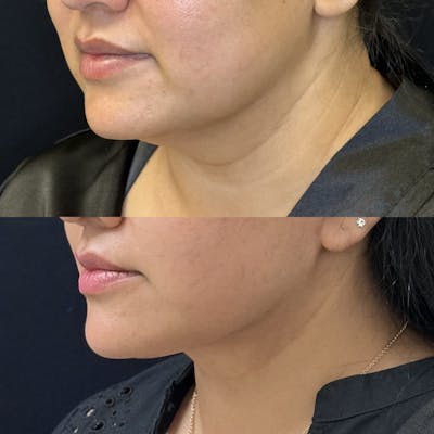 Deep Plane Facelift Before & After Gallery - Patient 736586 - Image 2