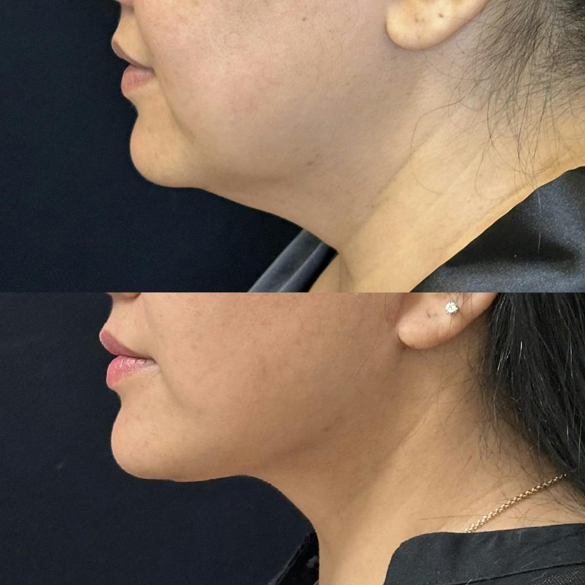 Necklift Before & After Gallery - Patient 310344 - Image 4
