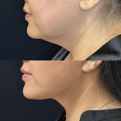 Deep Plane Facelift Before & After Gallery - Patient 736586 - Image 4