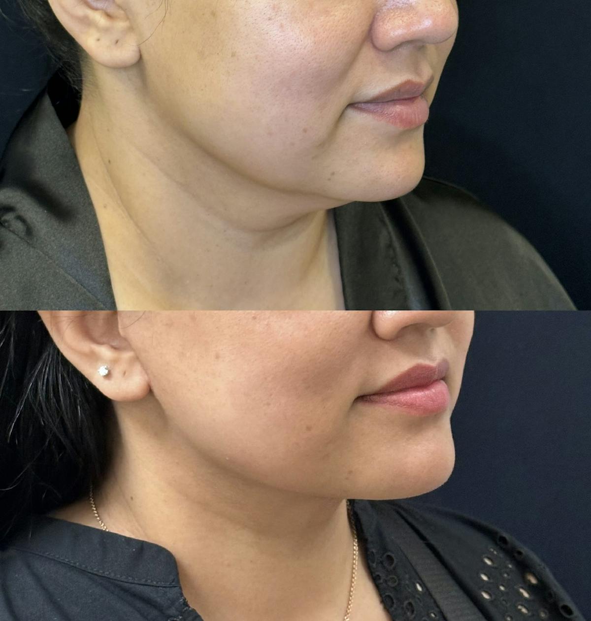 Necklift Before & After Gallery - Patient 310344 - Image 3