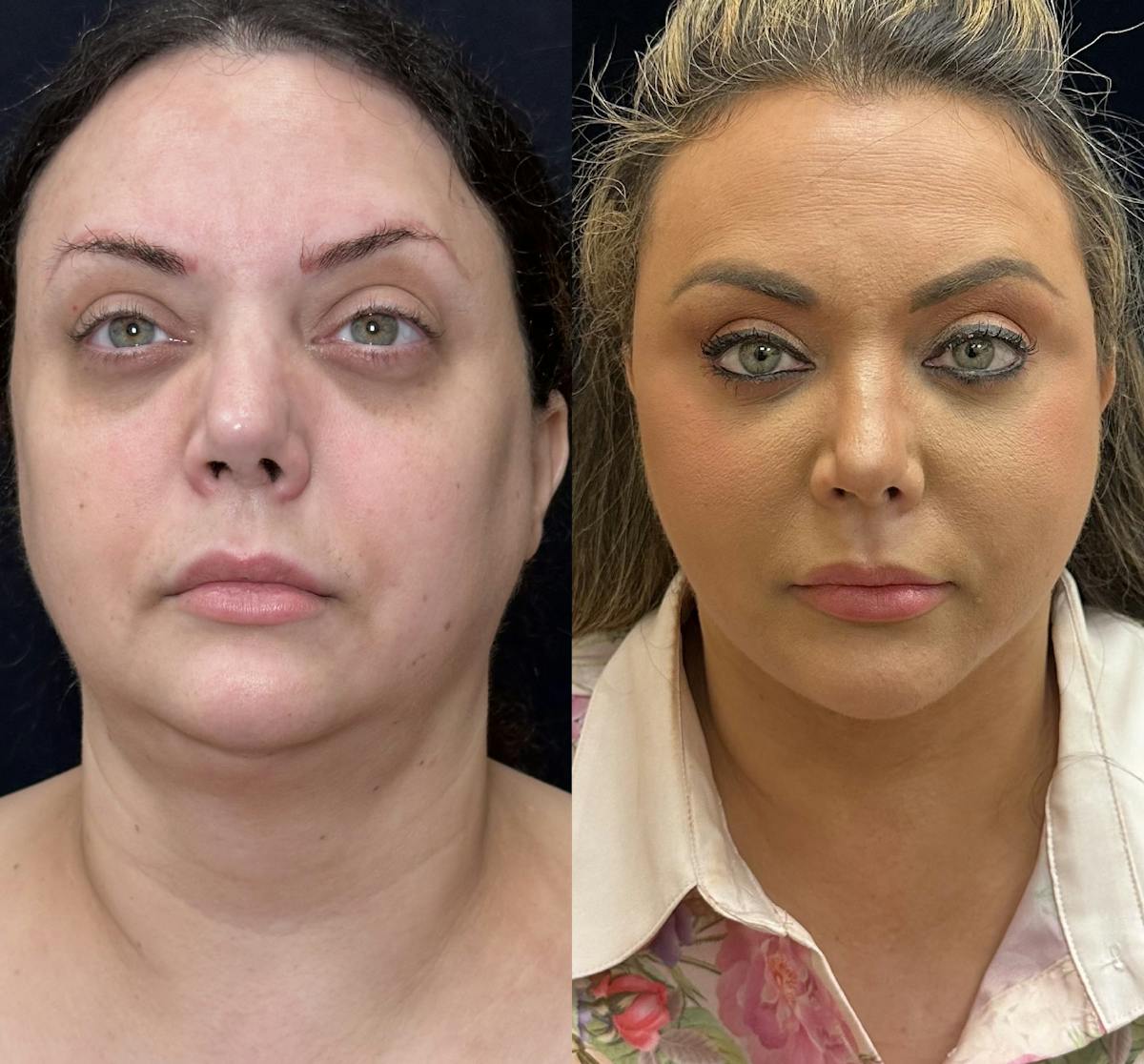 Buccal Fat Reduction Before & After Gallery - Patient 483424 - Image 5